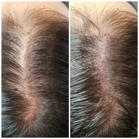 Scalp Micropigmentation Aftercare Guidelines - International Hairlines