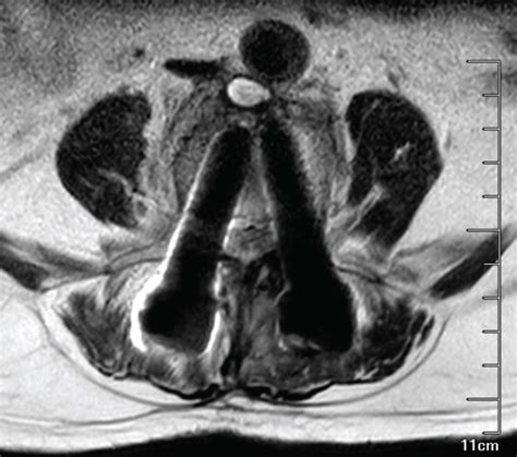 Preoperative MRI of the fourth and fifth lumbar spine. | Download Scientific Diagram