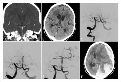 An 80-year-old female patient with acute basilar artery occlusion ...