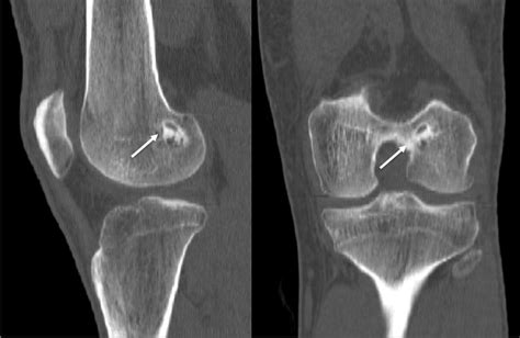 Biology of Graft Incorporation | Asian Journal of Arthroscopy