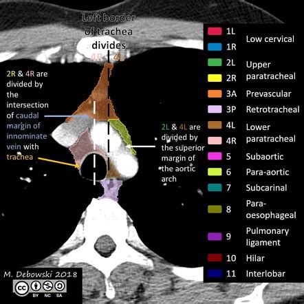 Thoracic lymph node stations | Radiology Reference Article | Radiopaedia.org