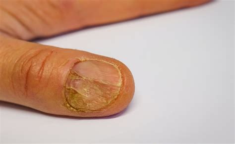 Nail Patella Syndrome: Genetic Anomalies in Nails & Bones