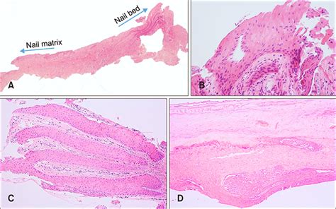 A Rare Case of Onychopapilloma Presenting as a Longitudinal Erythronychia