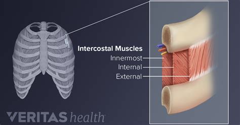 Upper Back Pain from Intercostal Muscle Strain