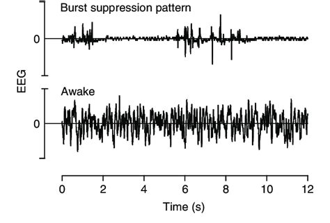 EEG pattern difference between burst suppression (top) and awake (bottom). | Download Scientific ...