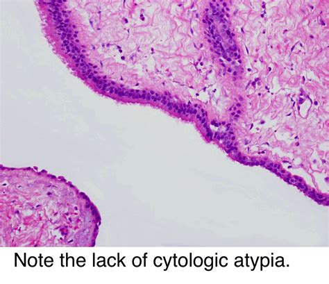 Pathology Outlines - Surgical ciliated cyst