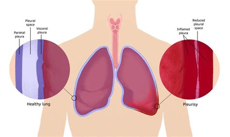 Learning Pleurisy: Symptoms, Causes, Diagnosis and Treatment - Health Sarthi