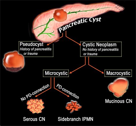 The Radiology Assistant : Pancreas - Cystic Lesions