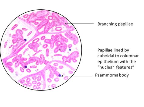 Papillary Carcinoma - Thyroid - Pathology Made Simple