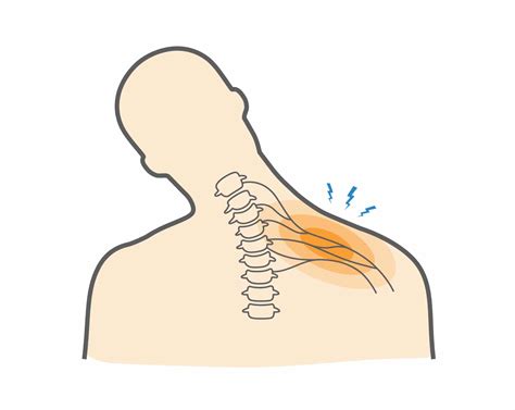 What is a Stinger & How to Deal with Nerve-Related Pain? - Upswing Health