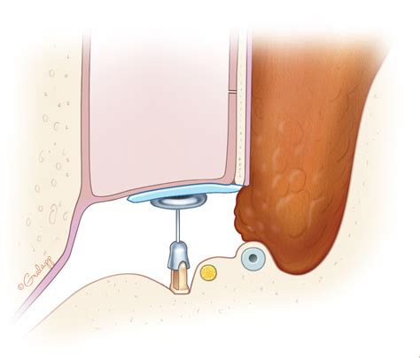 Mastoidectomy – Oto Surgery Atlas