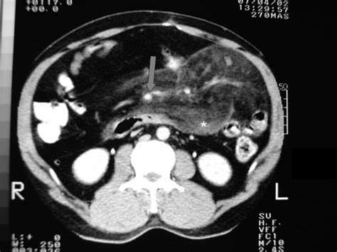 Mesenteric panniculitis with pedal edema in a 33-year-old Pakistani man ...