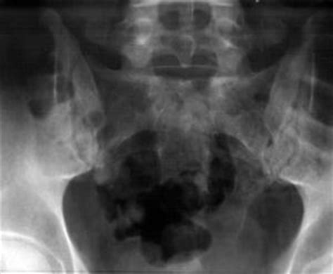 Complications of fractured pelvis | General center | SteadyHealth.com