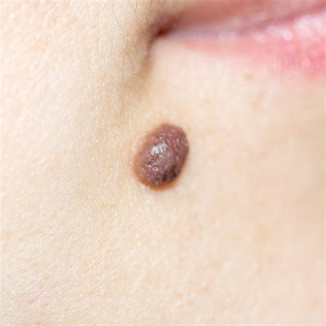 Understanding the different types of moles | Spot Check Clinic