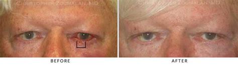 Eyelid Skin Cancer Excision Before and After Photo Gallery