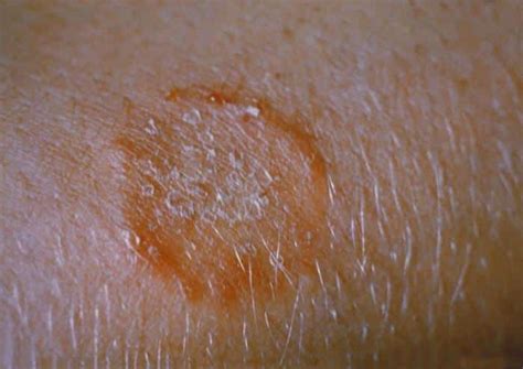 Ringworm in Dogs - Symptoms & Treatment // Perth Vet Care