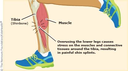 Shin Splints (for Parents) - Dayton Children's