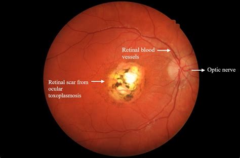 Toxoplasmosis Retina