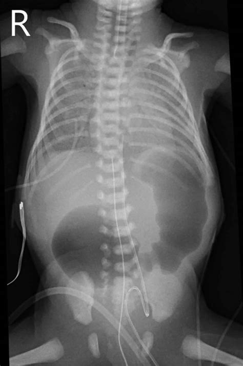 Duodenal atresia causes, symptoms, diagnosis, treatment & prognosis