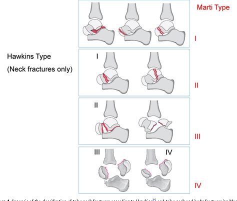 Figure 4 from Talar neck and body fractures. | Semantic Scholar