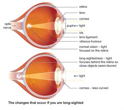 Can Laser Eye Surgery Cure Long Sightedness (Hyperopia)?