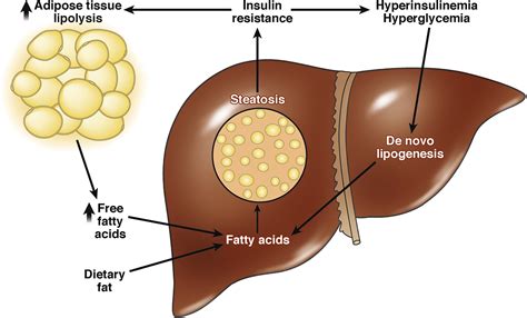 Treating Hepatic Steatosis and Fibrosis by Modulating Mitochondrial Pyruvate Metabolism ...