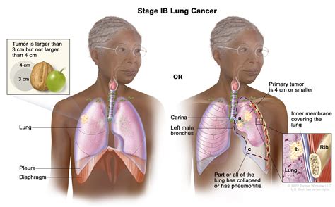 Non-Small Cell Lung Cancer Treatment (PDQ®) - NCI