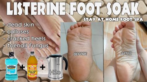 Listerine Vinegar Foot Bath Recipe | Deporecipe.co