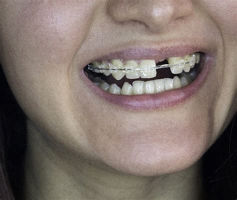 how to fix messed up teeth without braces - Rather Nicely Cyberzine ...