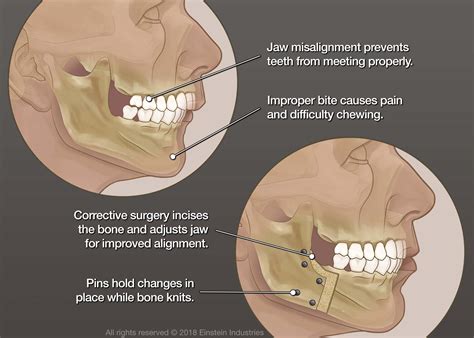 Jaw Surgery