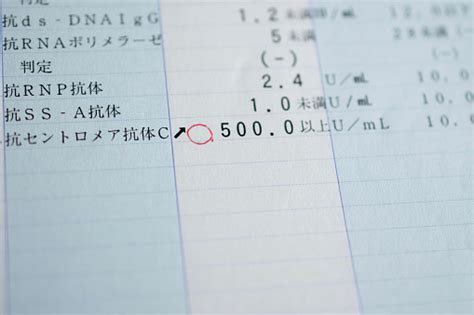 Blood Test Result Showing A High Anticentromere Antibody Level Stock Photo - Download Image Now ...