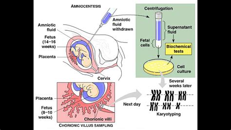 Amniocentesis And Cvs