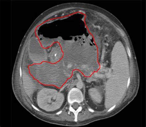 Intra-abdominal Abscess - MEDizzy