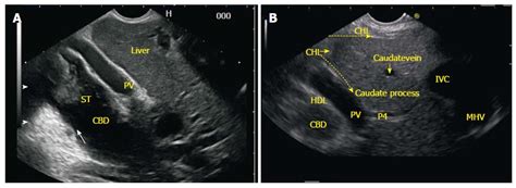 Vitelline Duct Ultrasound