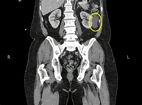 Cureus | Incidental Renal Cell Carcinoma in Pelvic Malignancies