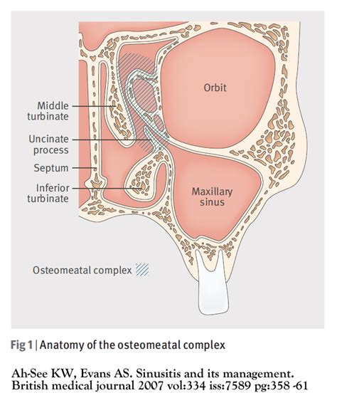 Sinusitis - Cancer Therapy Advisor