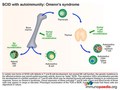 Severe Combined Immunodeficiency Case Study | Immunopaedia