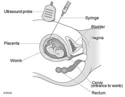 Chorionic villus sampling (CVS) and amniocentesis - Patient Information Brochures - Mater Group