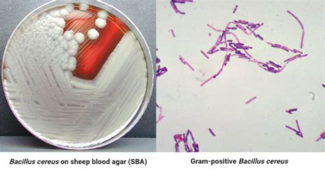 Bacillus cereus food poisoning with foodborne toxins