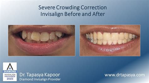 Severe Crowding Correction - Invisalign Before and After - YouTube