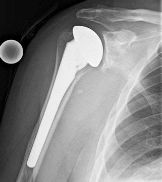 total-shoulder-replacement - DOCJOINTS//DR SUJIT JOS//Total joint ...