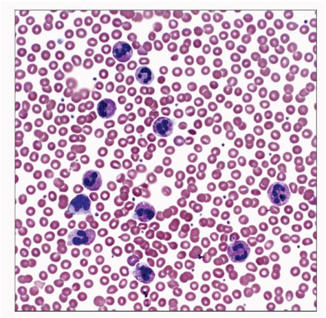 Chronic Neutrophilic Leukemia | Basicmedical Key