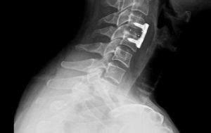 Remove Injured or Degenerative Spinal Discs With Cervical Fusion Surgery