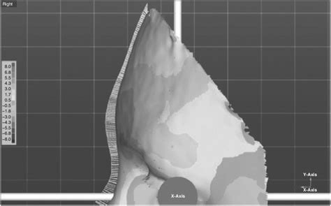 6 Colour deviation map with the scale on the left (-8 mm to +8 mm). The ...