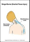 Sports Medicine Advisor 2003.1: Brachial Plexus Injury (Stinger/Burner)