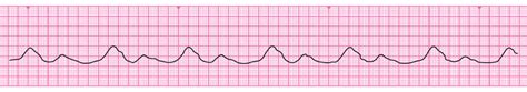 Resuscitation Council (UK) - Advanced Life Support - Escape and agonal ...