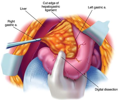 Omentum Cancer Symptoms, Survival Rate, Treatment « CancerWORLD Cancer Treatment Research Journal