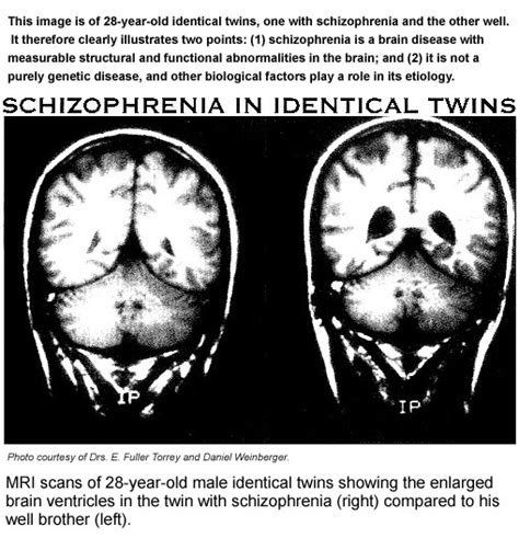 Schizophrenia in Identical Twins - Brain Scans
