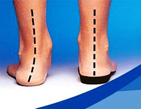 Custom Orthotics, Biomechanics, Overpronation and Running Injuries