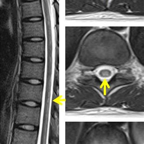 Abnormal Thoracic Mri